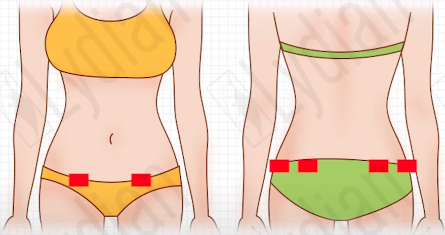 abdomen liposuction scar